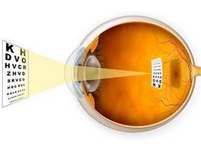 眼干燥症的类型都有哪些？